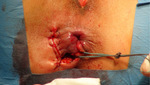 Small fot1 po operacji hipok fmt