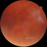Small laser 1 opt