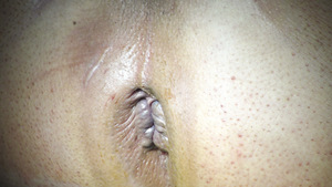Small fot2 zakrzepica brze%c2%bfn opt