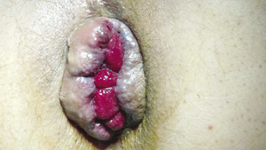 Small fot3 hemoroidy 4 st opt