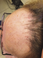 Small derm 326 rycina 4 opt