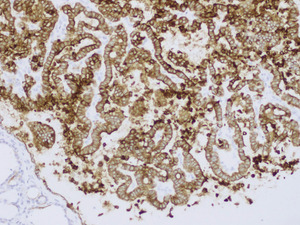 Small 6 ptc ck19 opt
