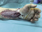 Small a1 opt