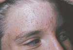 Small 3403 early inflammator opt