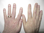 Small dermatomyositis2 opt