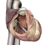 Small micra in heart opt