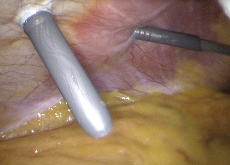 Medium 11 opt