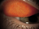 Small 4 alergia grudki spojo opt