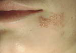 Small 0709 herpes simplex 1 opt