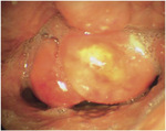 Small glynn opt