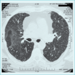 Small azpp ct fmt