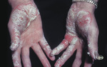 Small psoriasis on the hand2 opt