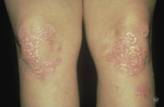 Small psoriasis on the legs opt