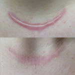 Small keloid 2 opt