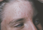 Small 3403 early inflammat opt