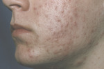 Small 3404 papular and pus opt